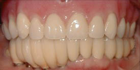 Dental Implants case #3260